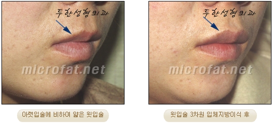 [Duhan Plastic Surgery Lip Surgery] - [Lip Correction Fat Grafting] image 15