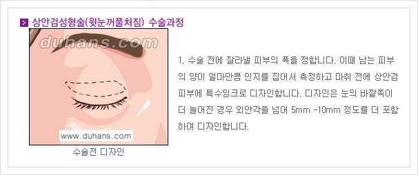 [두한성형외과 경쟁력 안검성형] - [상큼하고 환한 눈매의 완성 상안검 성형술 안내] 관련 이미지 1