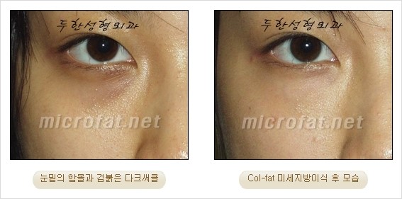 ​[두한성형외과 경쟁력 눈밑성형 리더] - [눈밑 다크써클의 증상, 원인, 종류, 치료방법 안내] 관련 이미지 29