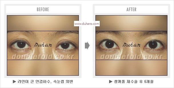 [두한성형외과 경쟁력 눈성형] - [나에게 맞는 어울리는 쌍꺼풀 라인] 관련 이미지 22
