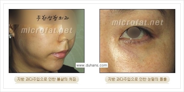 [두한성형외과 경쟁력 지방이식] - [미세지방이식, 자가지방이식, 지방주입의 잘못된 정보 안내] 관련 이미지 4
