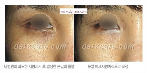 ⁠⁠[두한성형외과 경쟁력 안검성형] - [젊은 눈매를 위한 윗눈꺼풀 지방제거, 눈밑 지방제거] 관련 이미지 41