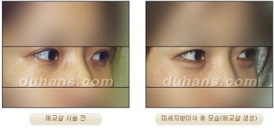[두한성형외과 얼굴자가지방이식] - [눈밑 애교살 시술을 위한 미세지방이식] 관련 이미지 4