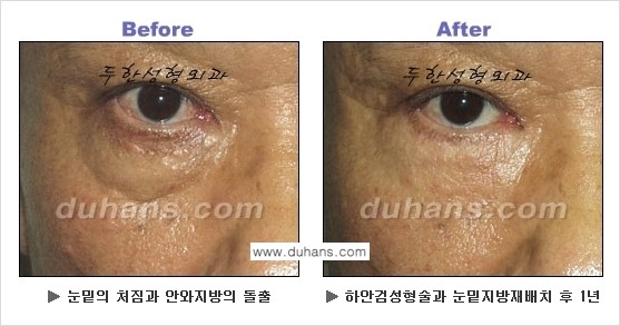 [두한성형외과의 상큼하고 환한 젊은 눈매완성] - [하안검 성형술 ①] 관련 이미지 5
