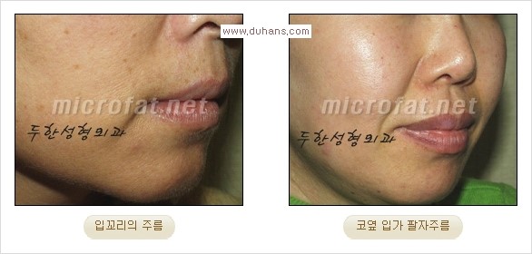 [두한성형외과 경쟁력 주름성형] - [코 옆과 입가에 걸쳐서 형성된 주름을 교정해주는 미세지방이식] 관련 이미지 1