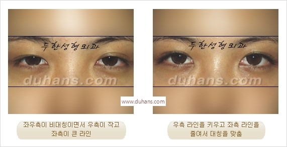 [두한성형외과 경쟁력 눈성형] - [나에게 맞는 어울리는 쌍꺼풀 라인] 관련 이미지 32