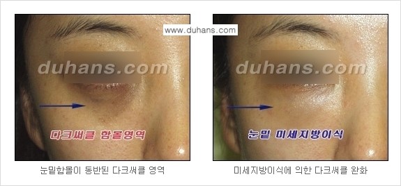 [두한성형외과 경쟁력 미세지방이식] - [다크써클 & 눈밑주름 미세지방이식 2.] 관련 이미지 8
