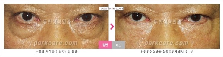 [두한성형외과 경쟁력 눈밑성형] - [눈밑 지방재배치의 문제점 안내] 관련 이미지 3