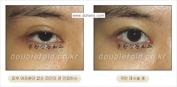 [두한성형외과 경쟁력 쌍꺼풀 재수술, 극한 눈재수술] - [망친 쌍꺼풀을 복원하는 극한 눈재수술] 관련 이미지 9
