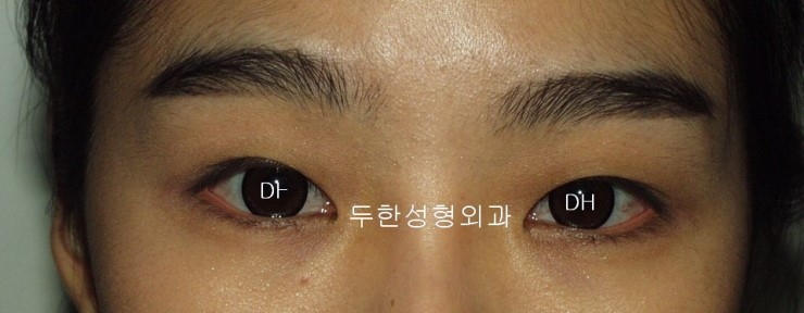 #쌍수 #쌍꺼풀 #쌍가풀 #쌍꺼플 #쌍꺼풀 #매몰 #눈수술 #쌍커풀 관련 이미지 1