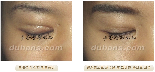 [두한성형외과 쌍커풀재수술] - [쌍커풀재수술 수술방법과 쌍커풀재수술 성공요건] 관련 이미지 42