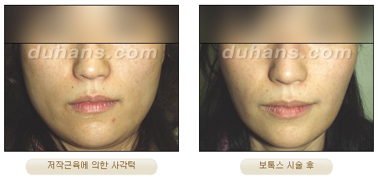 [두한성형외과 보톡스시술] - [사각턱 보톡스 안내] 관련 이미지 6