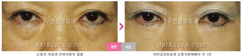 [두한성형외과 눈밑수술] - [눈밑지방재배치의 적응증] 관련 이미지 9
