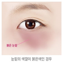 두한성형외과 눈밑수술 - 다크서클 수술 전후 관리 안내 관련 이미지 104