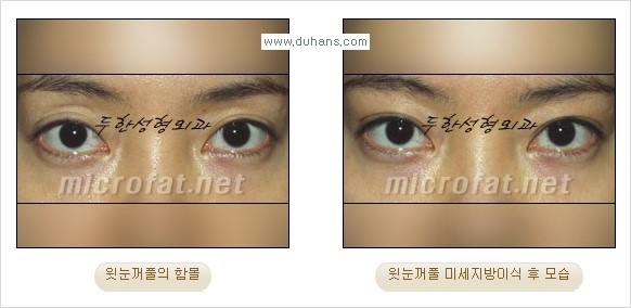 [두한성형외과 경쟁력 안검성형] - [꺼진 눈꺼풀, 눈꺼풀 함몰, 윗눈꺼풀 미세지방이식] 관련 이미지 23