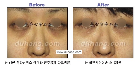 [두한성형외과의 상큼하고 환한 젊은 눈매완성] - [하안검 성형술 ②] 관련 이미지 22