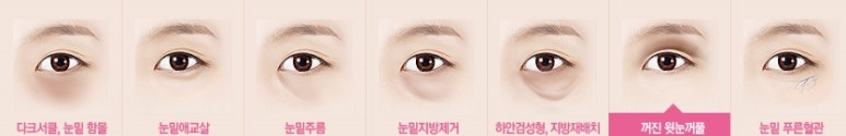 [두한성형외과 다크서클] - [다크서클 전후사진 검증] 관련 이미지 147