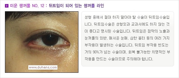 [두한성형외과 경쟁력 쌍꺼풀 재수술, 극한 눈재수술] - [자연스러운 눈매로의 복원 쌍꺼풀 재수술 대상 안내] 관련 이미지 13