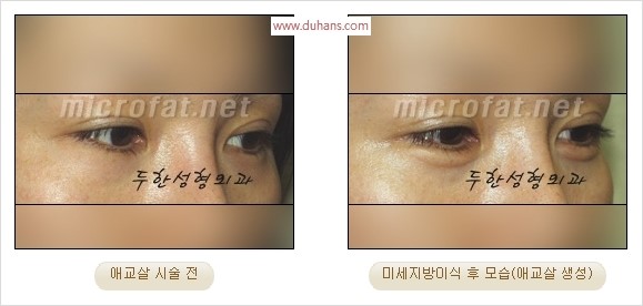 ​﻿[두한성형외과 경쟁력 지방이식] - [눈밑 애교살 시술을 위한 미세지방이식] 관련 이미지 41