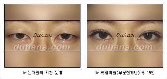 [두한성형외과 쌍커풀수술] - [눈성형 방법에 대한 자주하는 질문과 답변] 관련 이미지 112