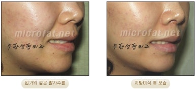 [Duhan Plastic Surgery Face Fat Grafting] - [Reducing Mouth Corners Wrinkles and Nasolabial Folds] image 20