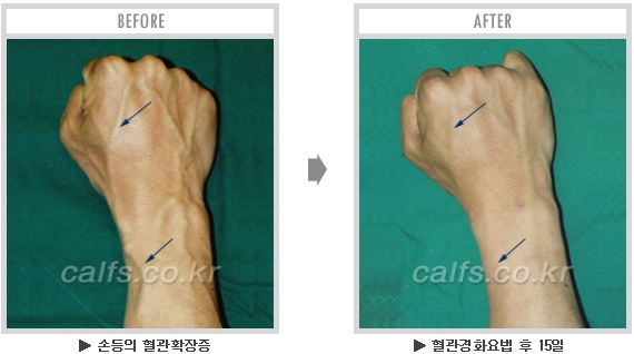 [종아리성형 두한성형외과] - [종아리수술에 대한 자주하는 질문과 답변 모음] 관련 이미지 50