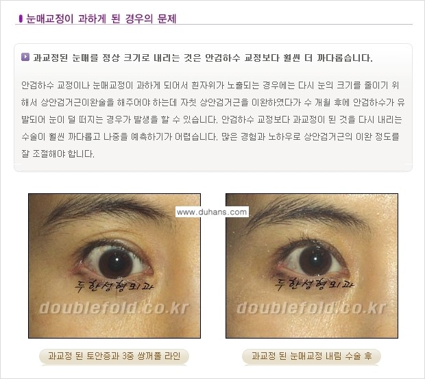[두한성형외과 극한 재수술, 쌍꺼풀 재수술] - [쌍꺼풀 재수술에서 극복해야 할 극한의 상황과 문제] 관련 이미지 10