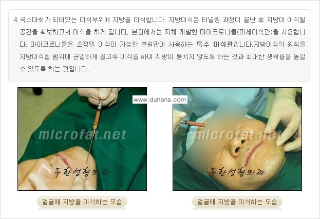 [두한성형외과의 경쟁력 있는 NO.1 지방이식] - [야윈 볼살 미세지방이식] 관련 이미지 10