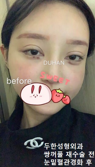 [Duhan Plastic Surgery Double Eyelid Revision Surgery] - [Asymmetric Eye Correction, Thick Ptosis, Lateral and Lower Canthoplasty] image 44