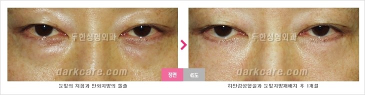 ​[두한성형외과 경쟁력 눈밑성형 리더] - [눈밑 다크써클의 증상, 원인, 종류, 치료방법 안내] 관련 이미지 71