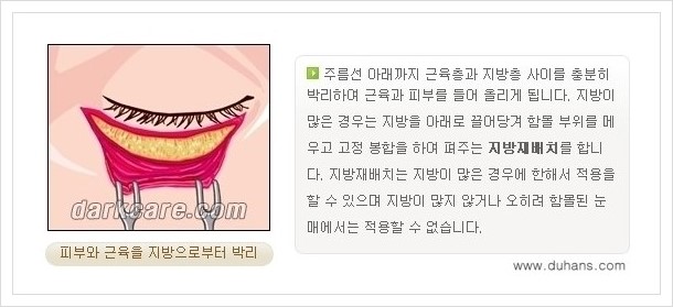 [두한성형외과 경쟁력 다크써클 치료] - [하안검 성형과 눈밑지방 재배치 안내] 관련 이미지 5