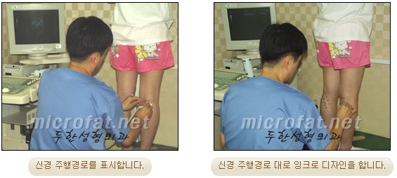 [Duhan Plastic Surgery Clinic Calf Contouring] - [Calf Reduction] image 7