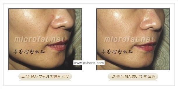 [두한성형외과 경쟁력 미세지방이식] - [귀족수술과 인디언밴드(앞광대주름) 미세지방이식] 관련 이미지 15