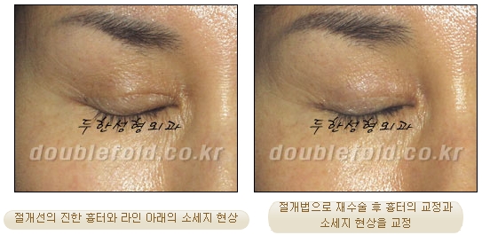 [두한성형외과 쌍커풀수술] - [눈성형 방법에 대한 자주하는 질문과 답변] 관련 이미지 22
