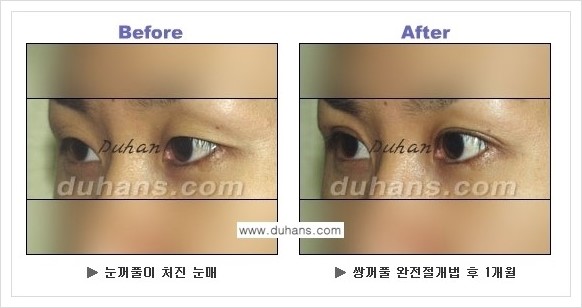 [두한성형외과 경쟁력 눈성형] - [퀵쌍꺼풀 수술 전후 정보 안내 ②] 관련 이미지 5