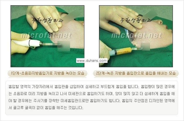 [두한성형외과 경쟁력 지방흡입] - [얼굴 지방흡입 부작용 교정방법 안내] 관련 이미지 9