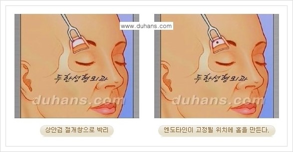 [두한성형외과 경쟁력 주름교정술] - [엔도타인 리프팅 안내 ③] 관련 이미지 3