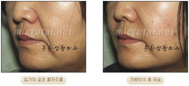 [Duhan Plastic Surgery Face Fat Grafting] - [Reducing Mouth Corners Wrinkles and Nasolabial Folds] image 11