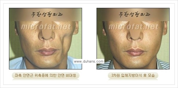 [두한성형외과 경쟁력 윤곽성형] - [볼, 볼살 지방이식] 관련 이미지 28