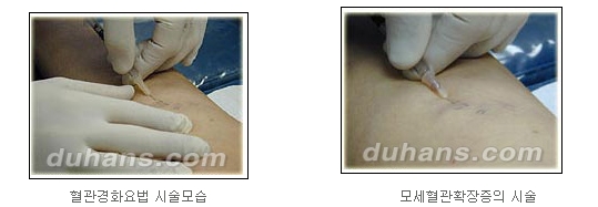 [두한성형외과 정맥류] - [하지정맥류, 정맥확장증, 혈관확장증] 관련 이미지 10