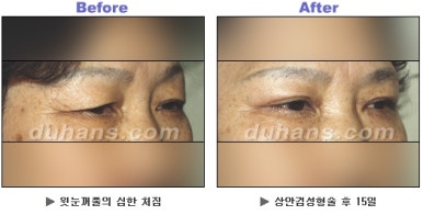 [Duhan Plastic Surgery Blepharoplasty] - [Upper Eyelid Surgery for a Younger-Looking Eye Area] image 9