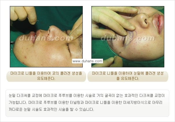 [두한성형외과 경쟁력 미세지방이식] - [탄력있는 피부와 윤곽을 만들어주는 Col-fat 지방이식] 관련 이미지 6