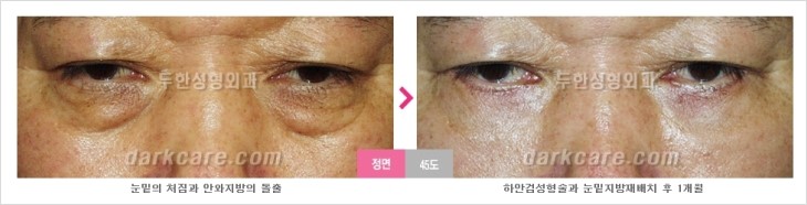 ​[두한성형외과 경쟁력 눈밑성형 리더] - [눈밑 다크써클의 증상, 원인, 종류, 치료방법 안내] 관련 이미지 69