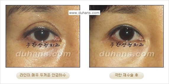 ⁠⁠⁠⁠[두한성형외과 성형 FOCUS] - [정상적인 눈매로의 복원 극한재수술 경우 ①] 관련 이미지 3