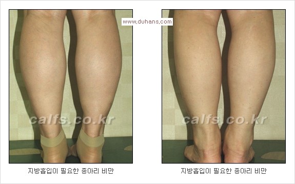 [두한성형외과 경쟁력 멀티종아리성형] - [종아리(다리) 비만 해결 방법 안내] 관련 이미지 1