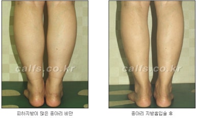 ​[두한성형외과 종아리수술] - [나에게 맞는 종아리성형방법] 관련 이미지 30