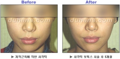 [Duhan Plastic Surgery Clinic Aesthetic Procedures] - [Square Jaw Botox] image 30