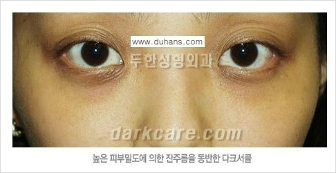 [두한성형외과 경쟁력 눈밑성형] - [다크써클의 원인과 다크써클의 종류] 관련 이미지 9