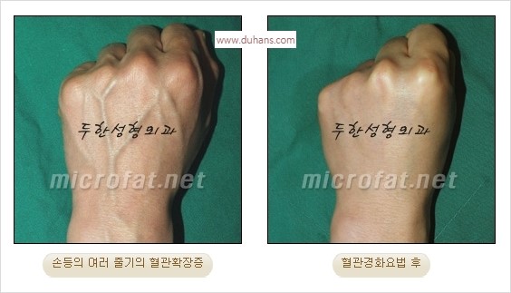 [두한성형외과 경쟁력 정맥류] - [손, 팔의 정맥확장증(혈관확장증) 치료 방법 안내] 관련 이미지 11