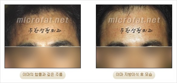 [두한성형외과 경쟁력 지방이식 리더] - [Col-fat(콜펫)지방이식, 3차원 입체지방이식, 2차원 평면지방이식] 관련 이미지 71